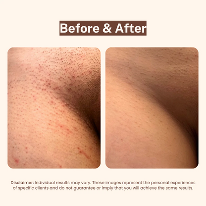 SoftLine™ BBL Serum